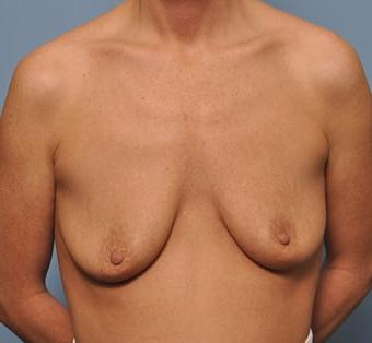 25P Saggy breast vol 27