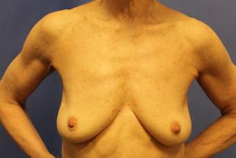 25P Saggy breast vol 28