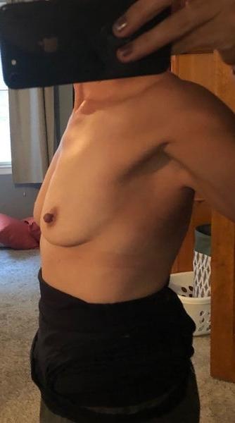 25P Saggy breast vol 25