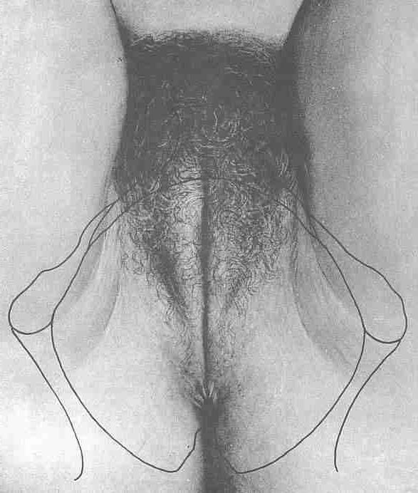 25P gyno mix1