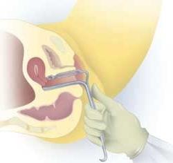 25P gyno mix1