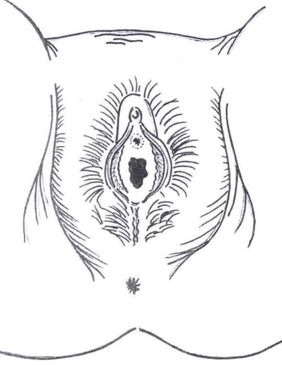 25P gyno mix1