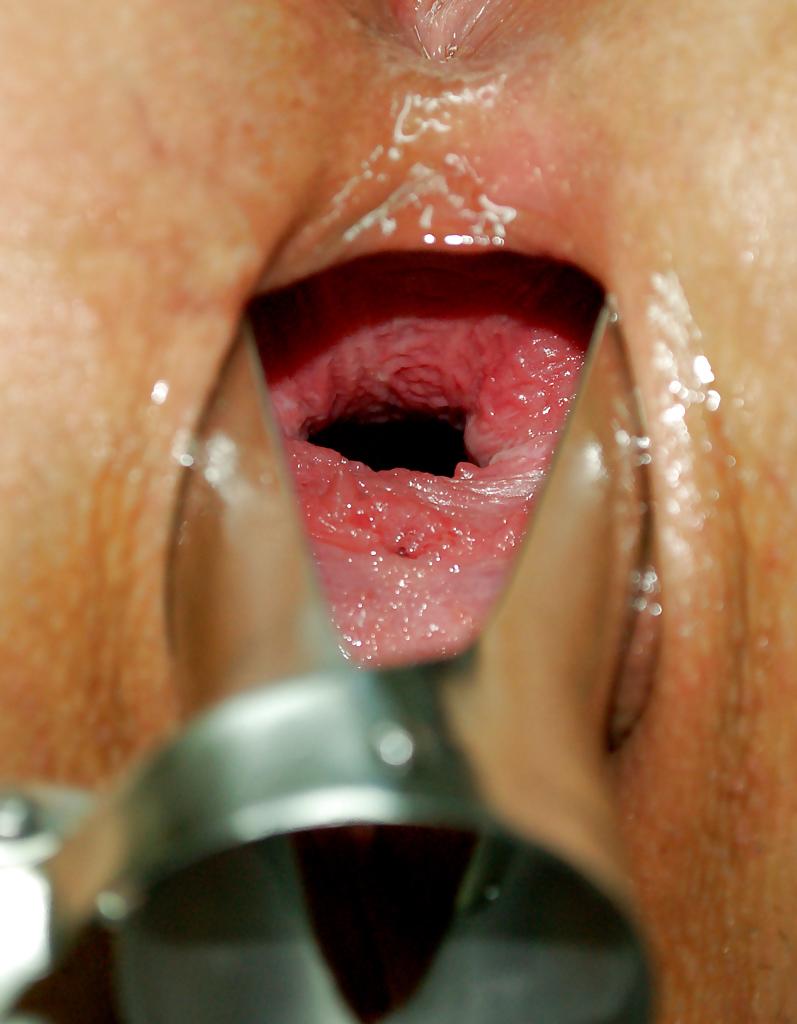 25P Bulgarian Girl Gapeing with Speculum