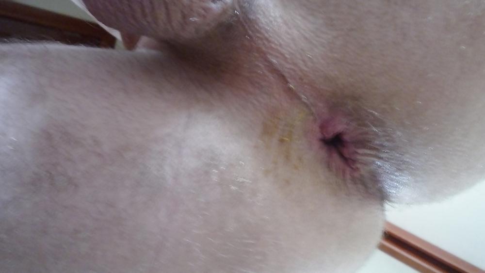 17P Deep penetration