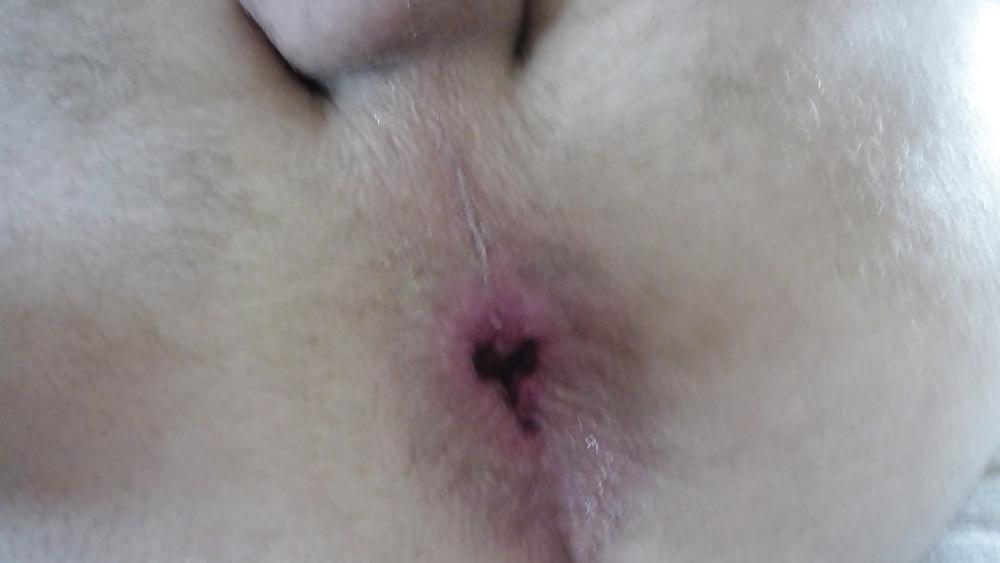 17P Deep penetration