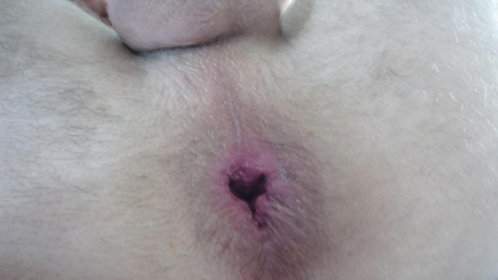 17P Deep penetration