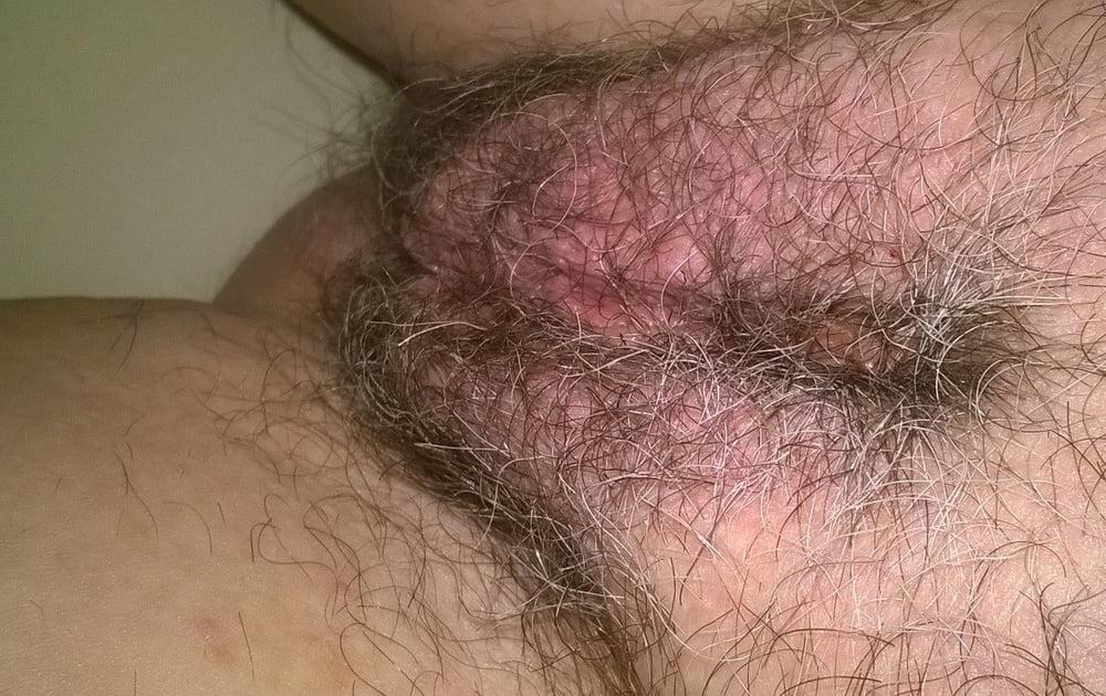 5P Hairy