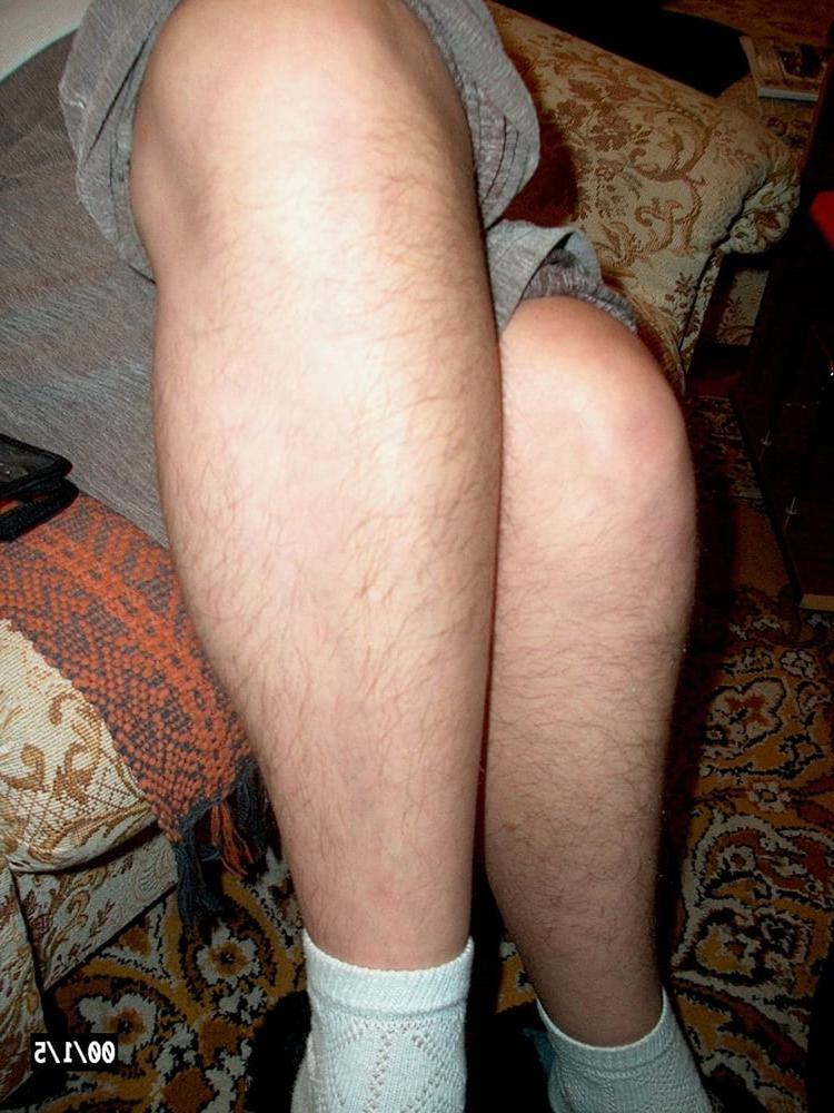 10P Hairy legs 1