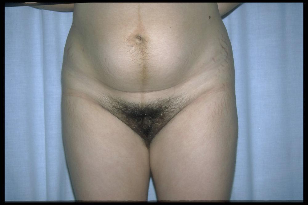 6P Full bush pregnant 5