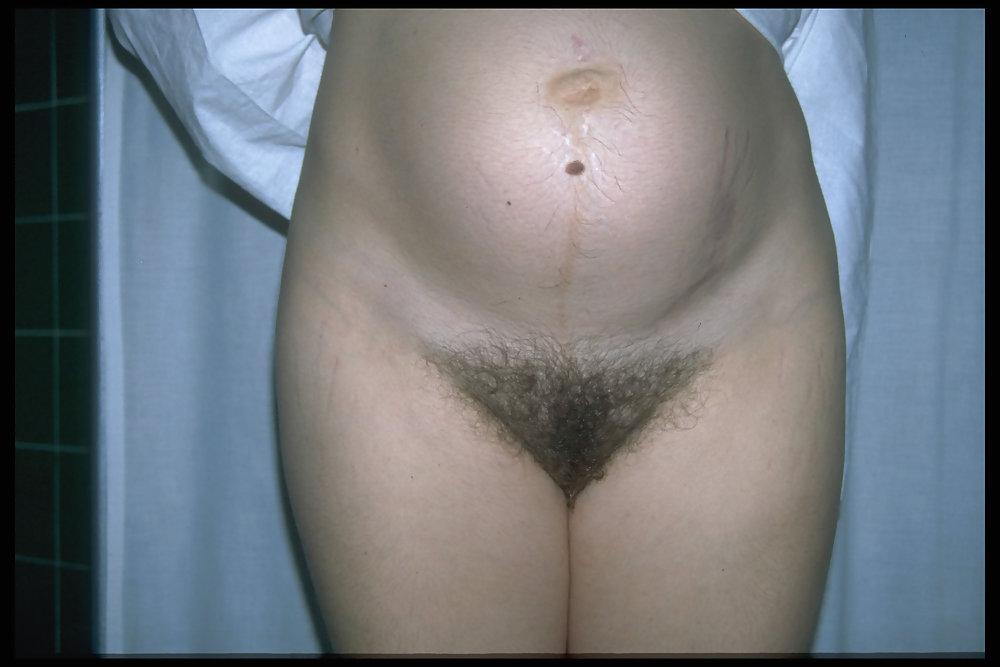 6P Full bush pregnant 5