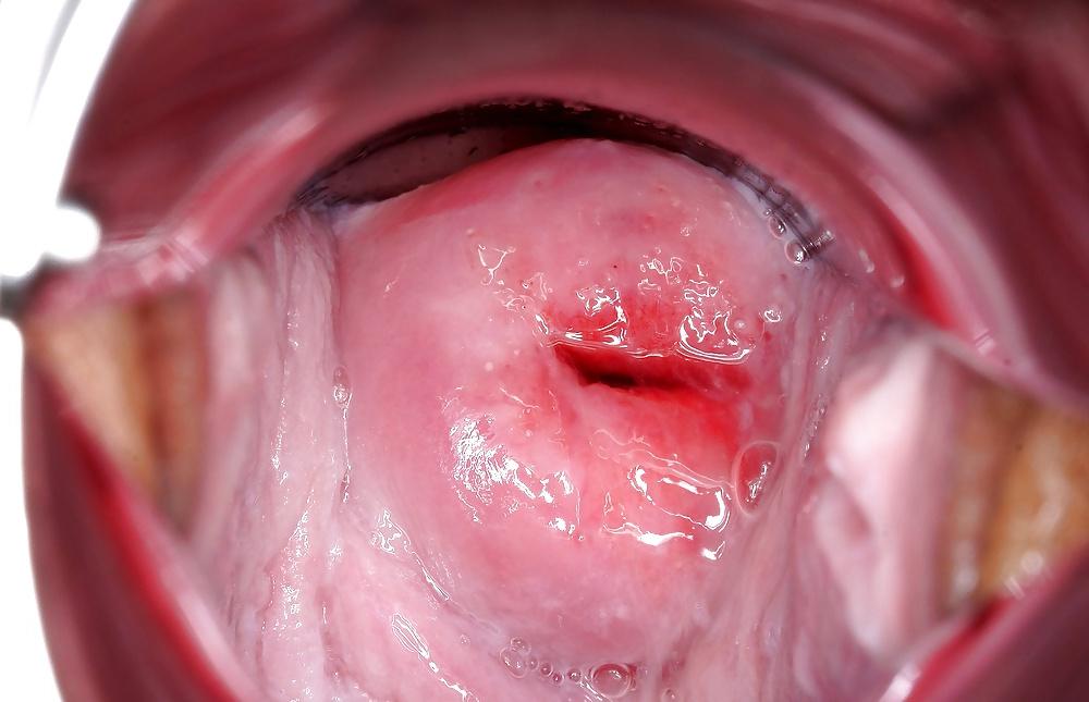8P Cum deep, Speculumn