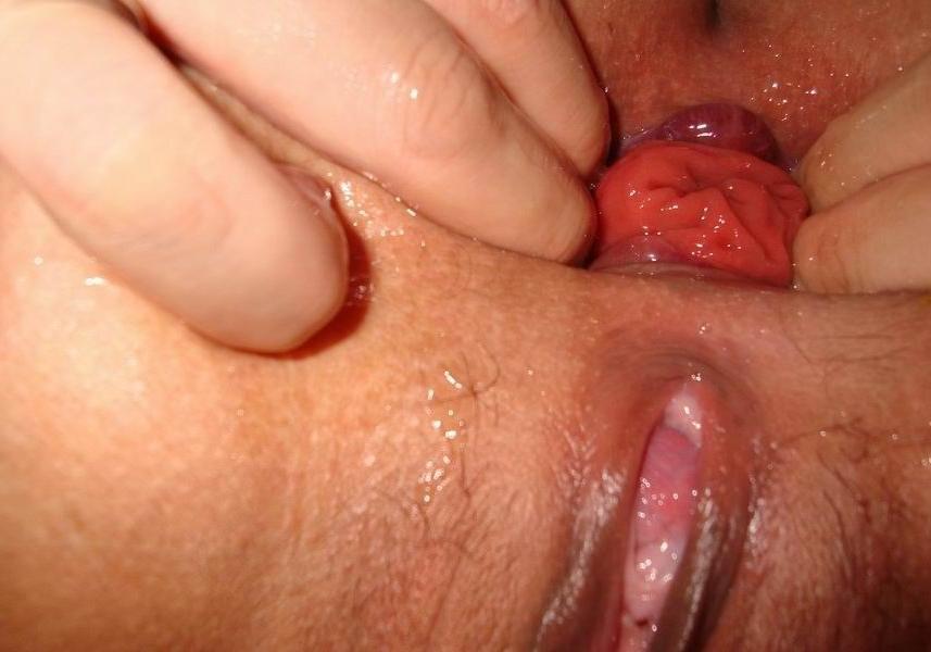 15P Extremely gaping ass hole