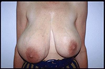 18P The Beauty of Fucked Up Tits Big and Small