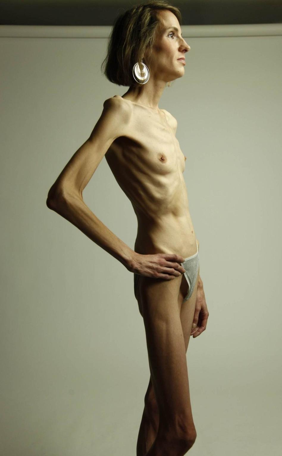 15P skinny anorexic girls posing nude for food