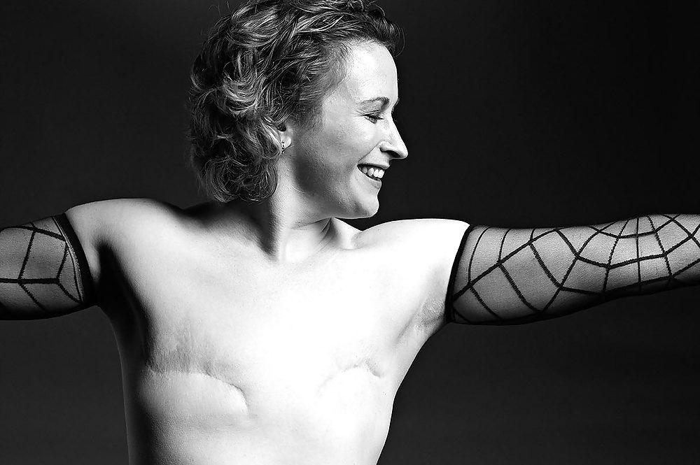 24P Beauty beyond the scar