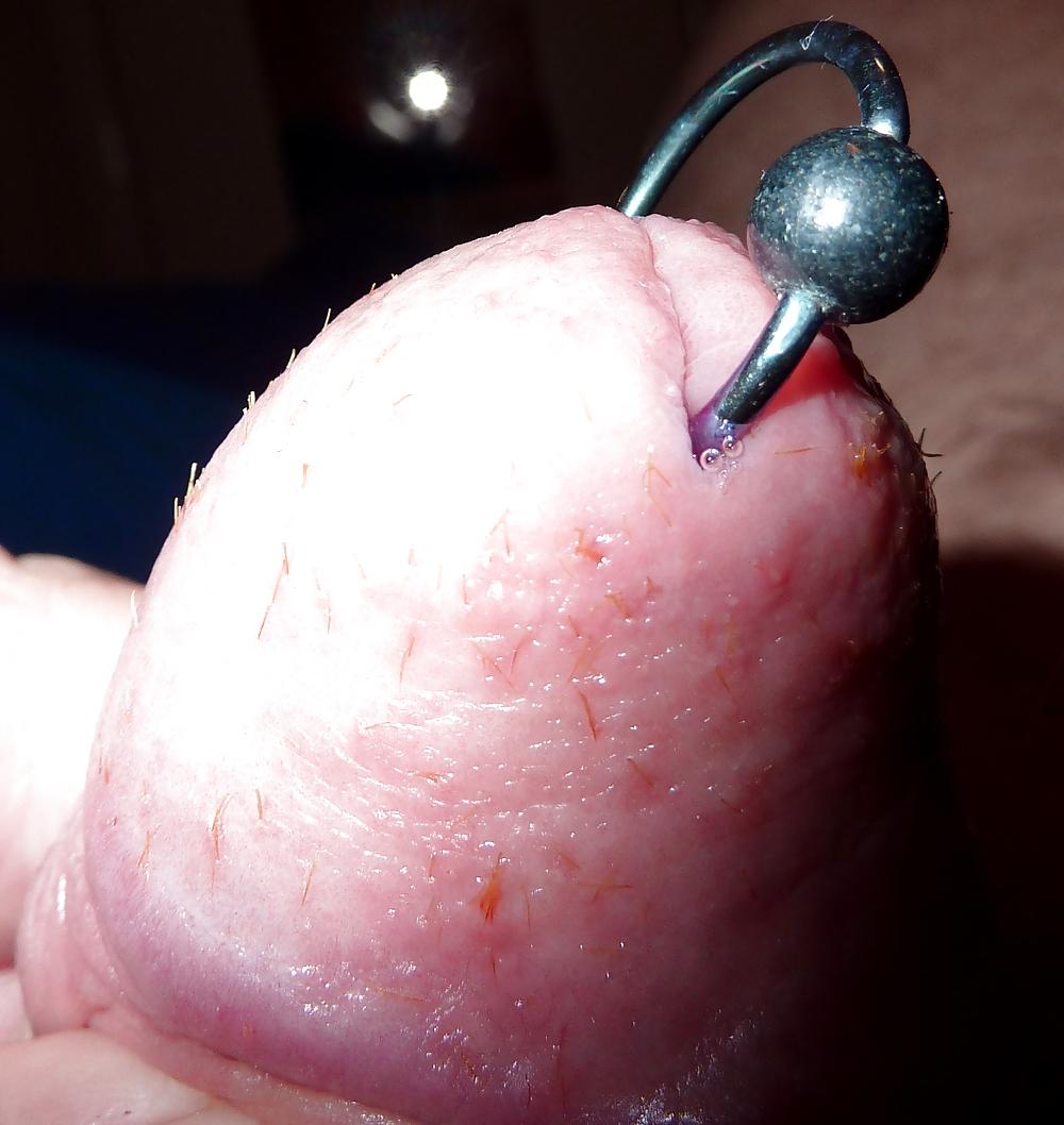 5P 72 hours LESS SPLINTERS BUT PAIN IS EXCRUCIATING