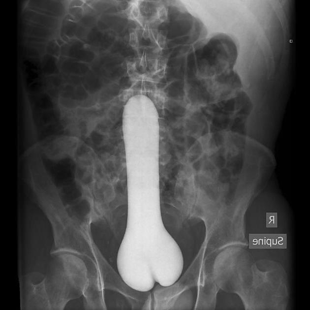 25P X-Rayed Sex