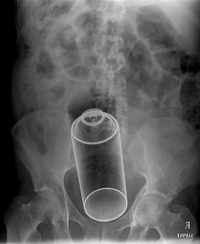 25P X-Rayed Sex