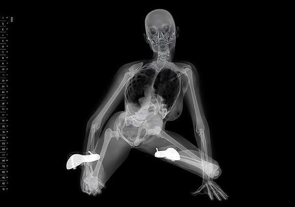 25P X-Rayed Sex