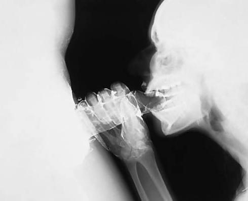 25P X-Rayed Sex