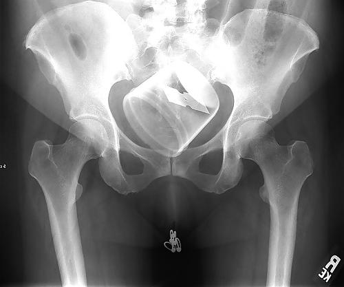 25P X-Rayed Sex