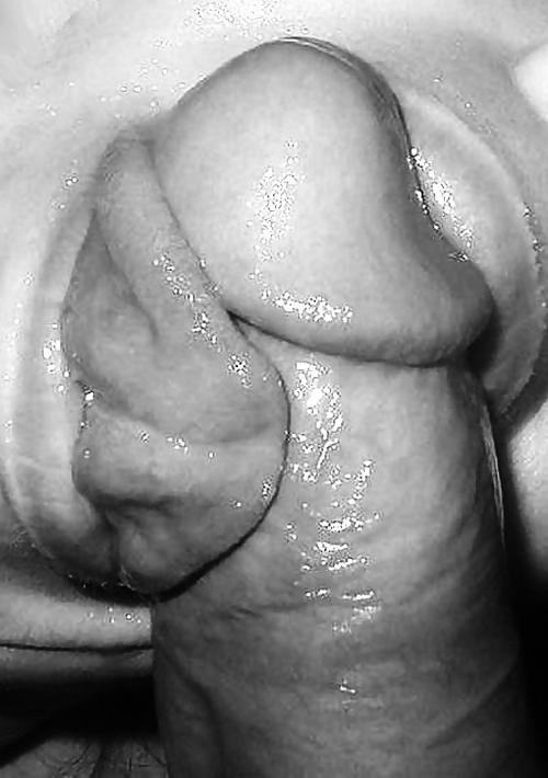 25P Oral