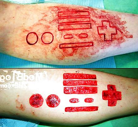 22P Teens and  Scarification -  Body Modification