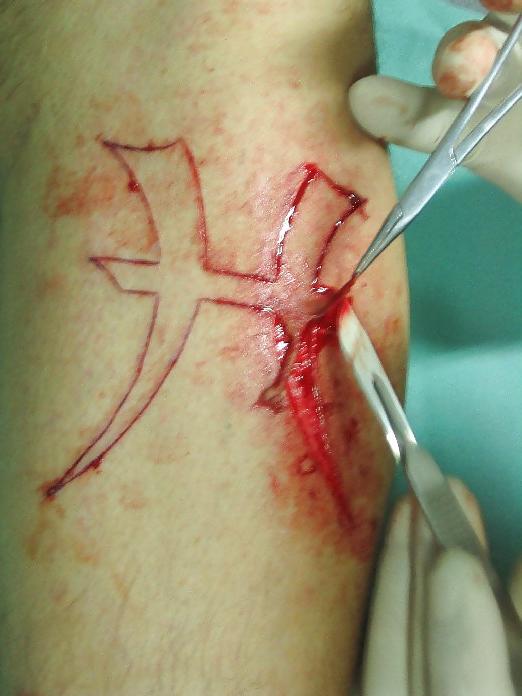 22P Teens and  Scarification -  Body Modification