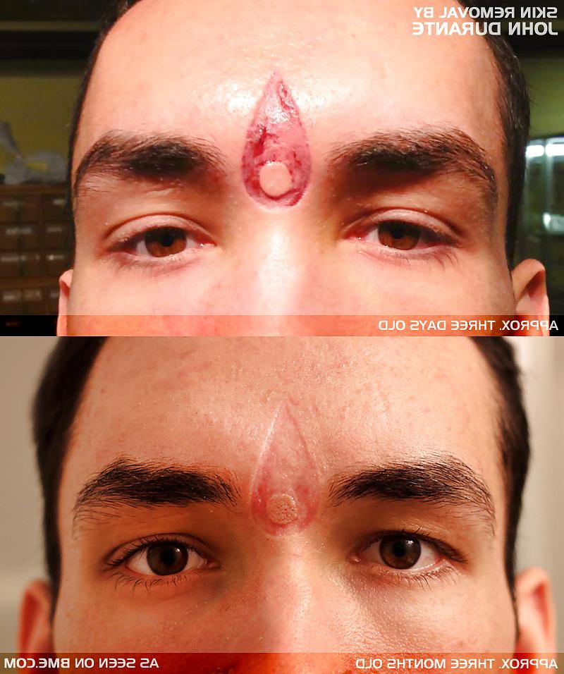 22P Teens and  Scarification -  Body Modification