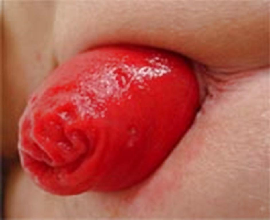 11P Anal prolapse is a yummy lollipop