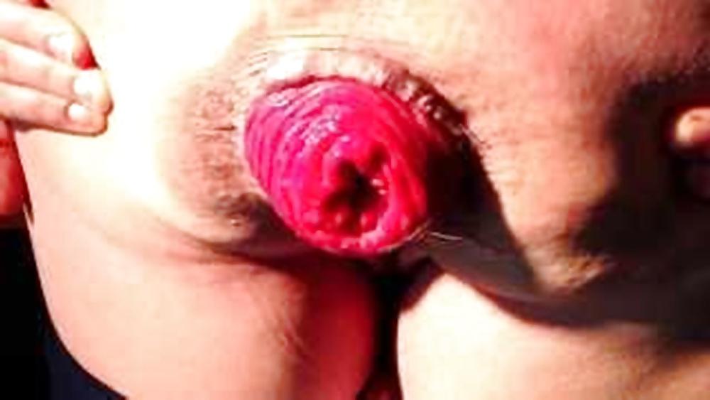 11P Anal prolapse is a yummy lollipop