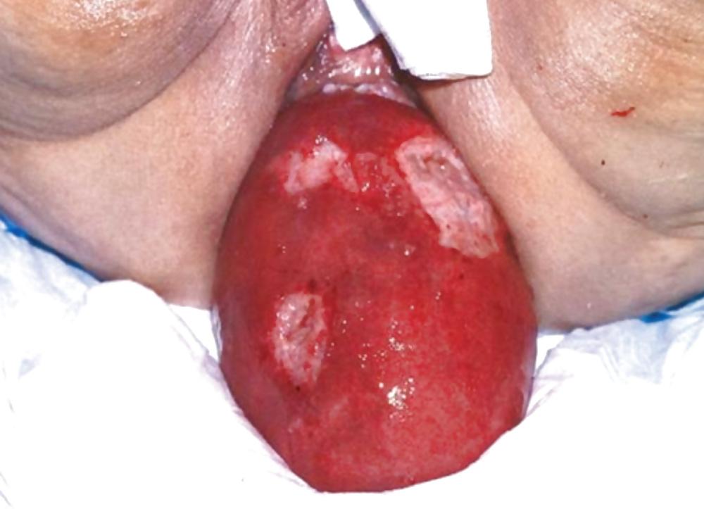 11P Anal prolapse is a yummy lollipop