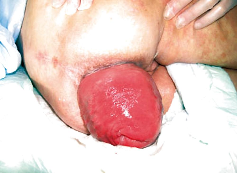 11P Anal prolapse is a yummy lollipop