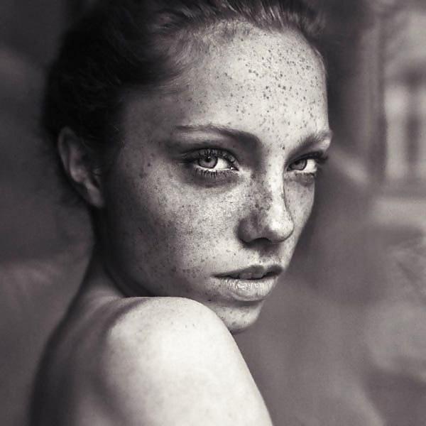 25P Just freckles....