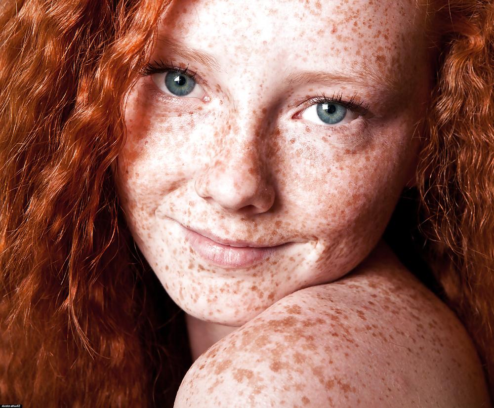 13P Lovely  Freckles
