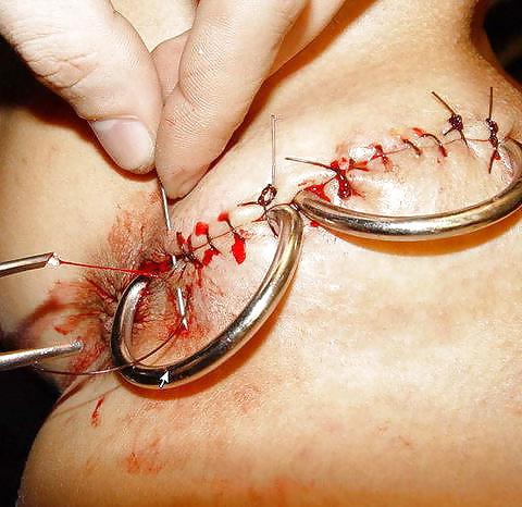 17P Pain Torture