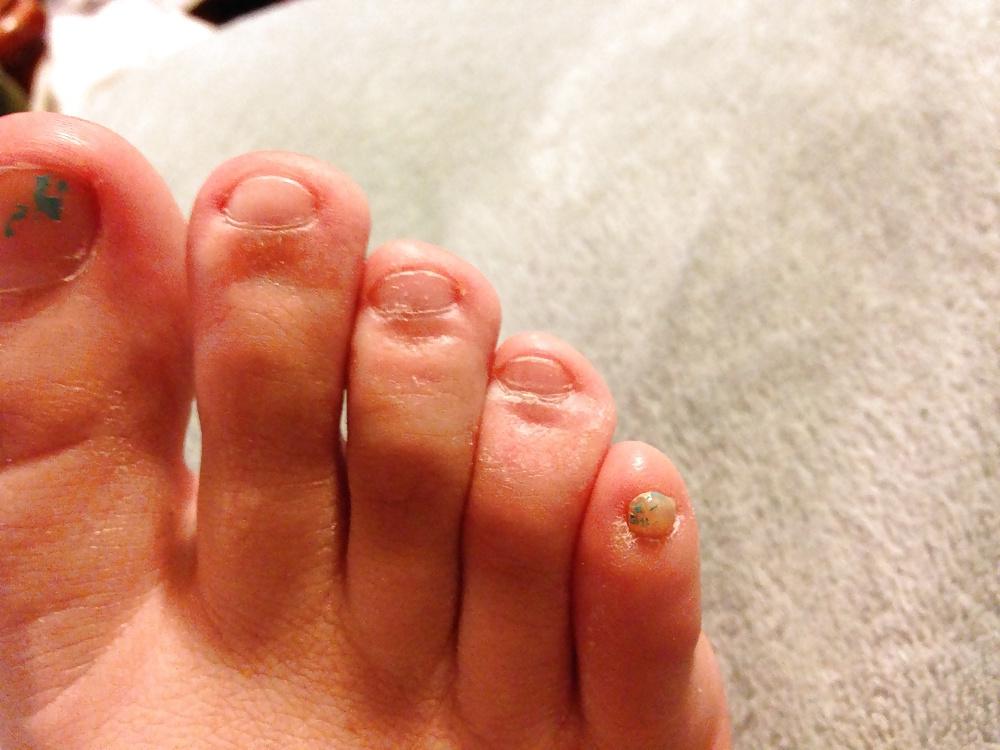 6P Toe or foot pain