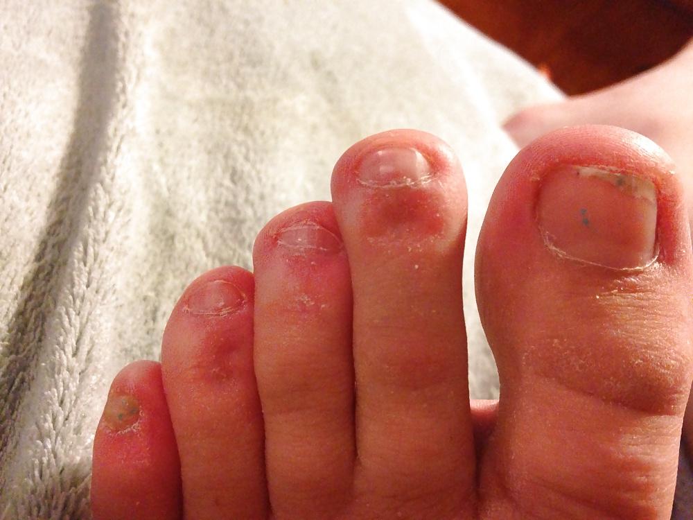 6P Toe or foot pain