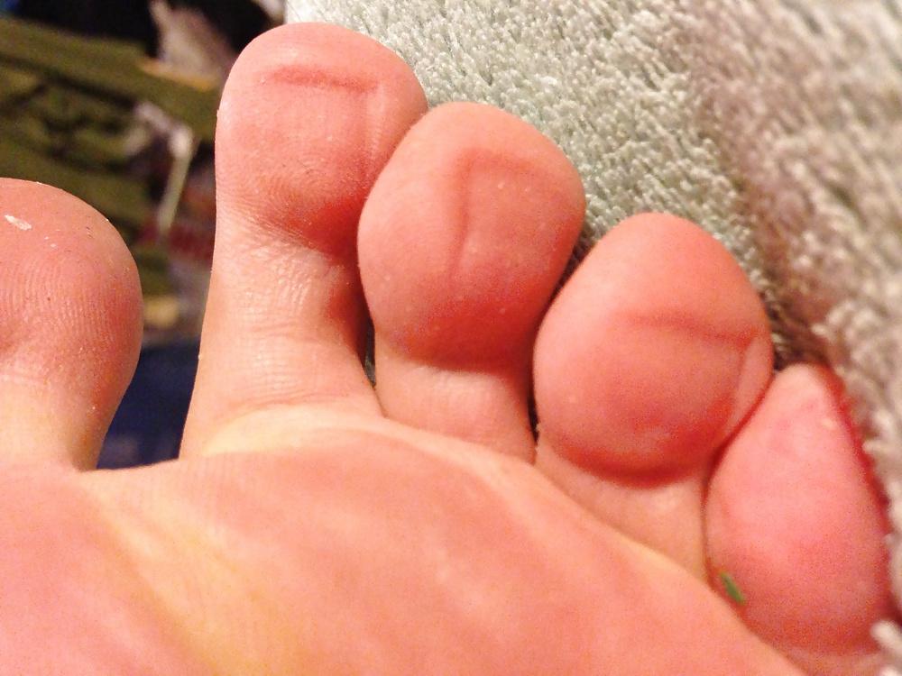 6P Toe or foot pain