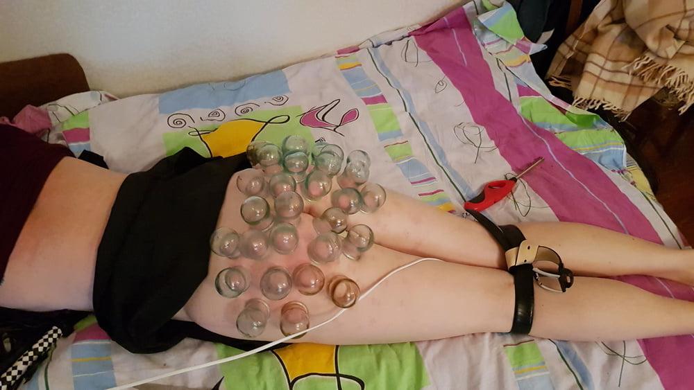 15P firecupping on buttocks