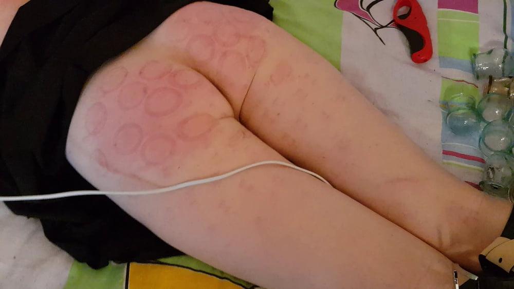 15P firecupping on buttocks