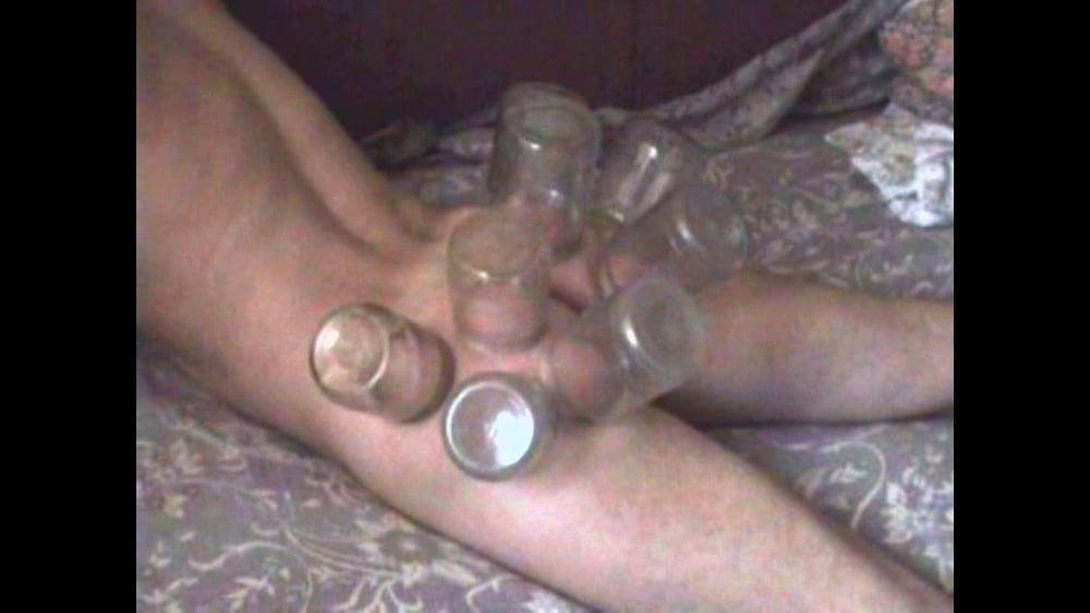 15P firecupping on buttocks