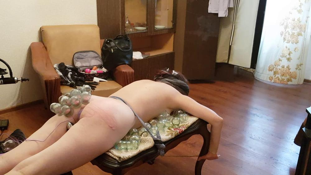 15P firecupping on buttocks