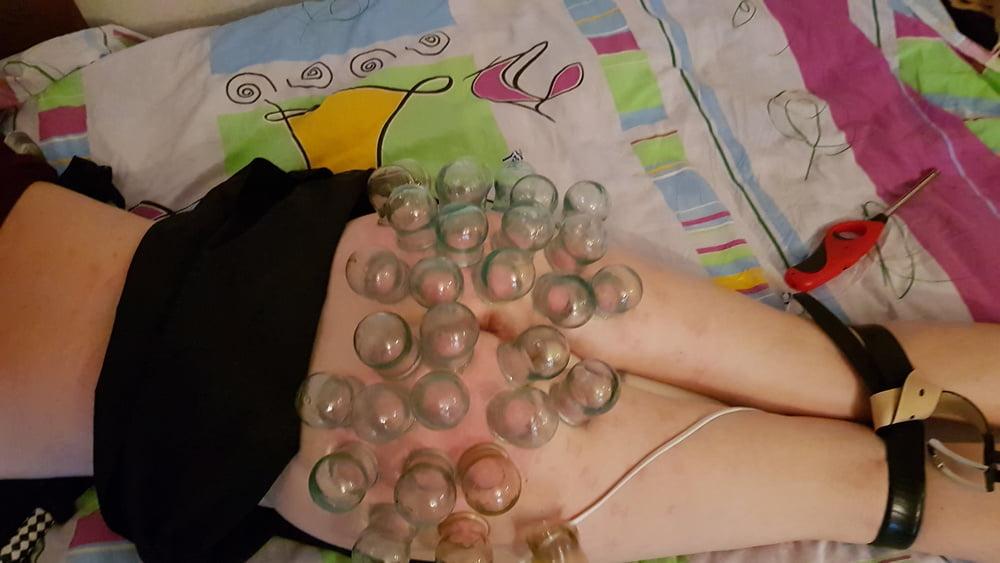 15P firecupping on buttocks