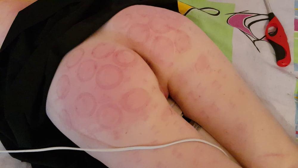15P firecupping on buttocks