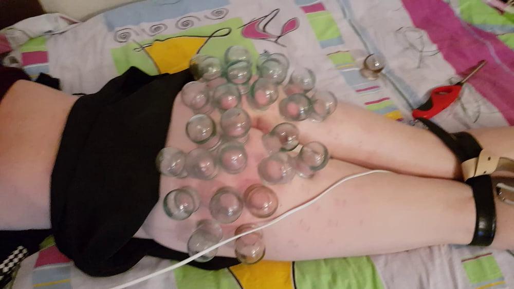 15P firecupping on buttocks