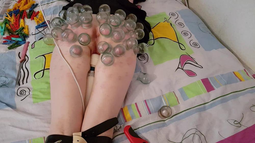 15P firecupping on buttocks