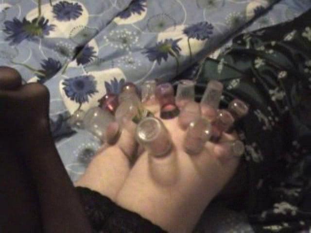 15P firecupping on buttocks