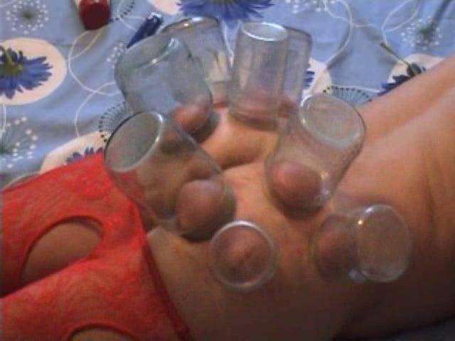 15P firecupping on buttocks