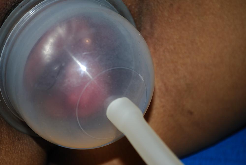 25P Thai pump Fotze dick